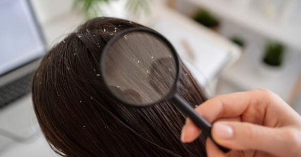 Reduces Dandruff